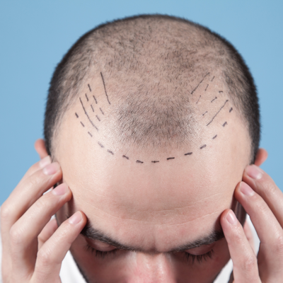 Quand réaliser une greffe capillaire ?