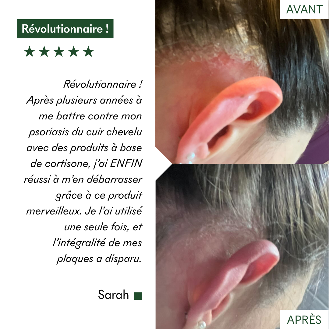 Ce protocole anti-psoriasis et plaques sèches de MakeMyMask est révolutionnaire, voici mon avant-après