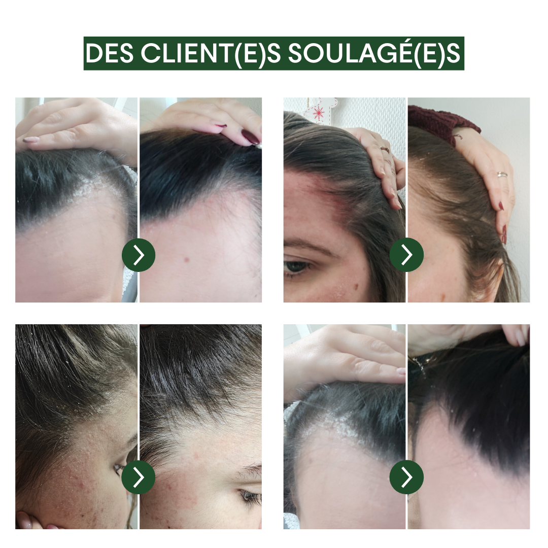 Concentré Anti-PSO & Plaques