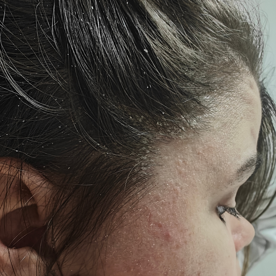 Psoriasis du cuir chevelu : comprendre et apaiser naturellement