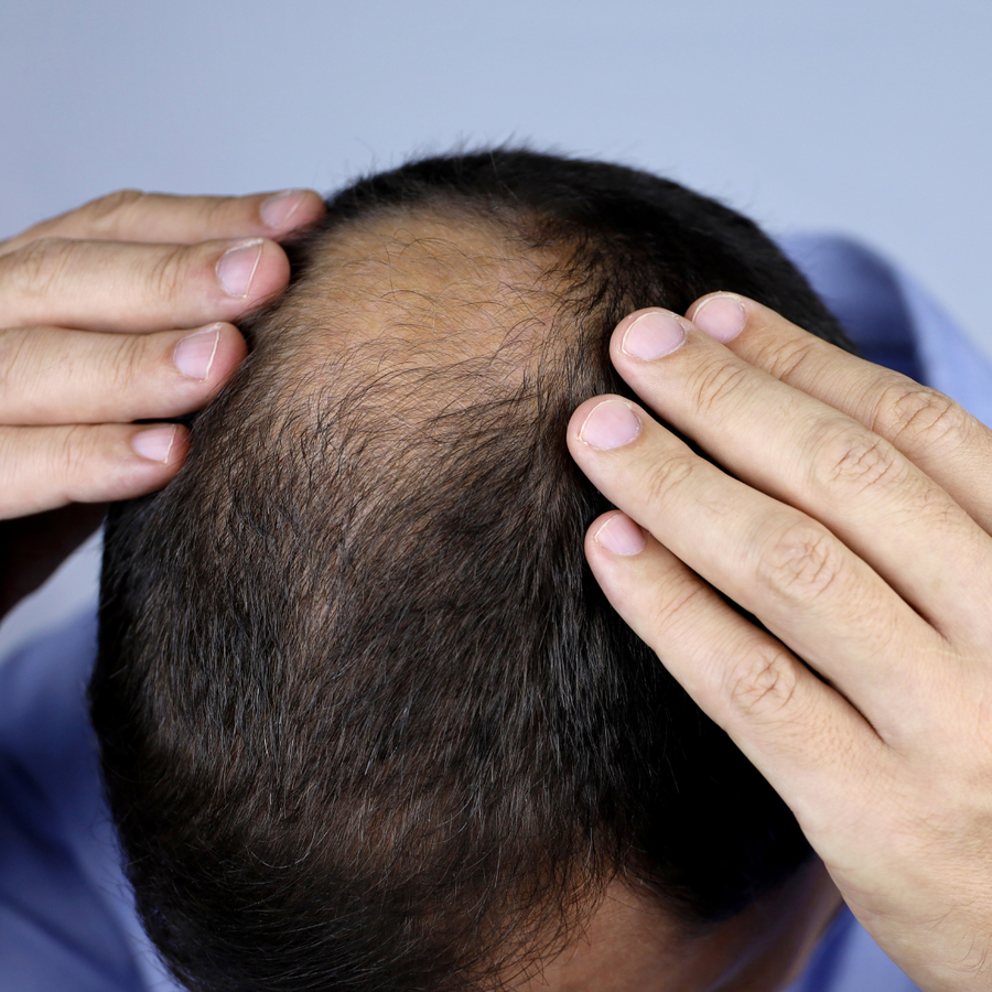 Bloqueur de DHT : la solution naturelle contre la chute de cheveux hormonale