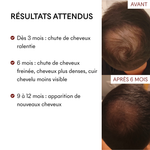 DHT Blocker Anti-Chute Hormonale