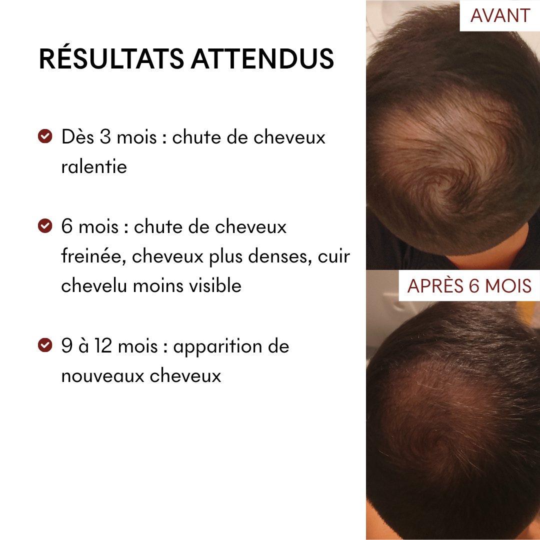 DHT Blocker Anti-Chute Hormonale