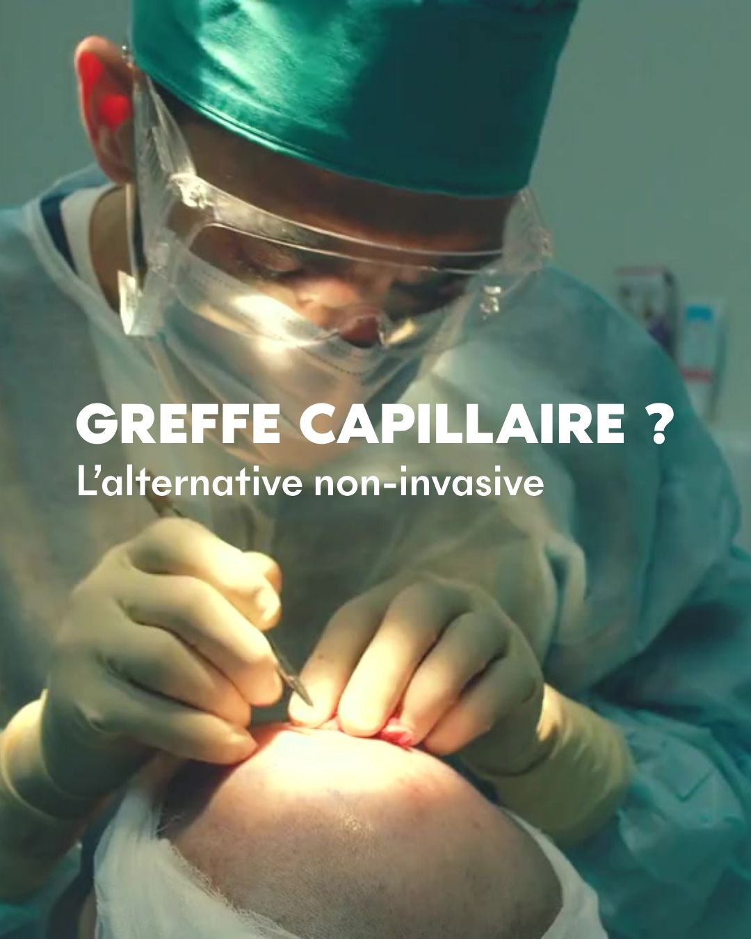 UNE VERITABLE ALTERNATIVE À LA GREFFE CAPILLAIRE