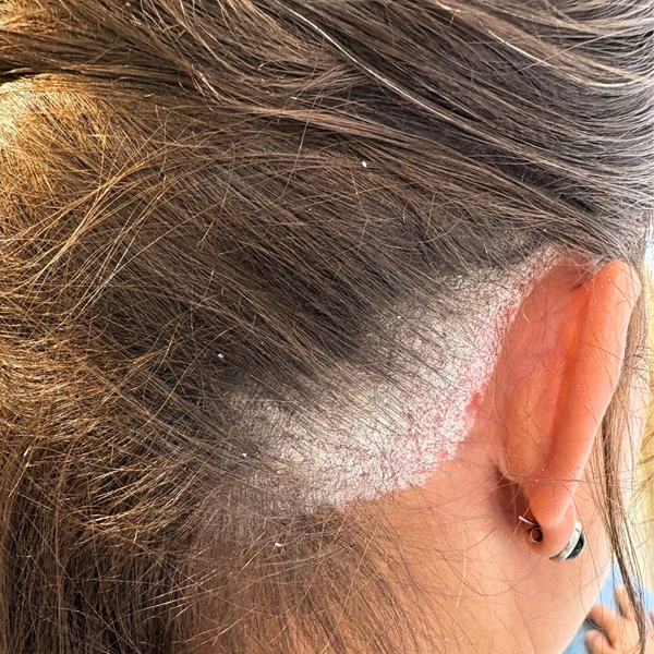 Comprendre & soulager le psoriasis du cuir chevelu