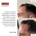 DHT Blocker Anti-Chute Hormonale